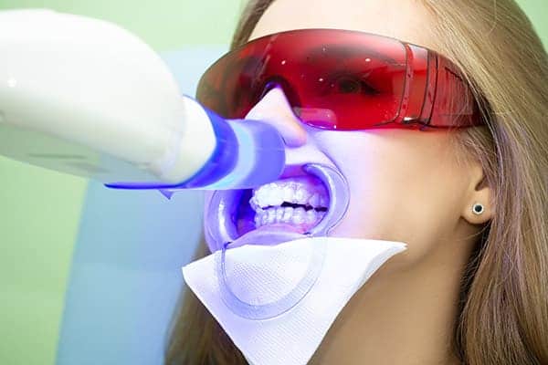 Laser teeth whitening treatments Slough