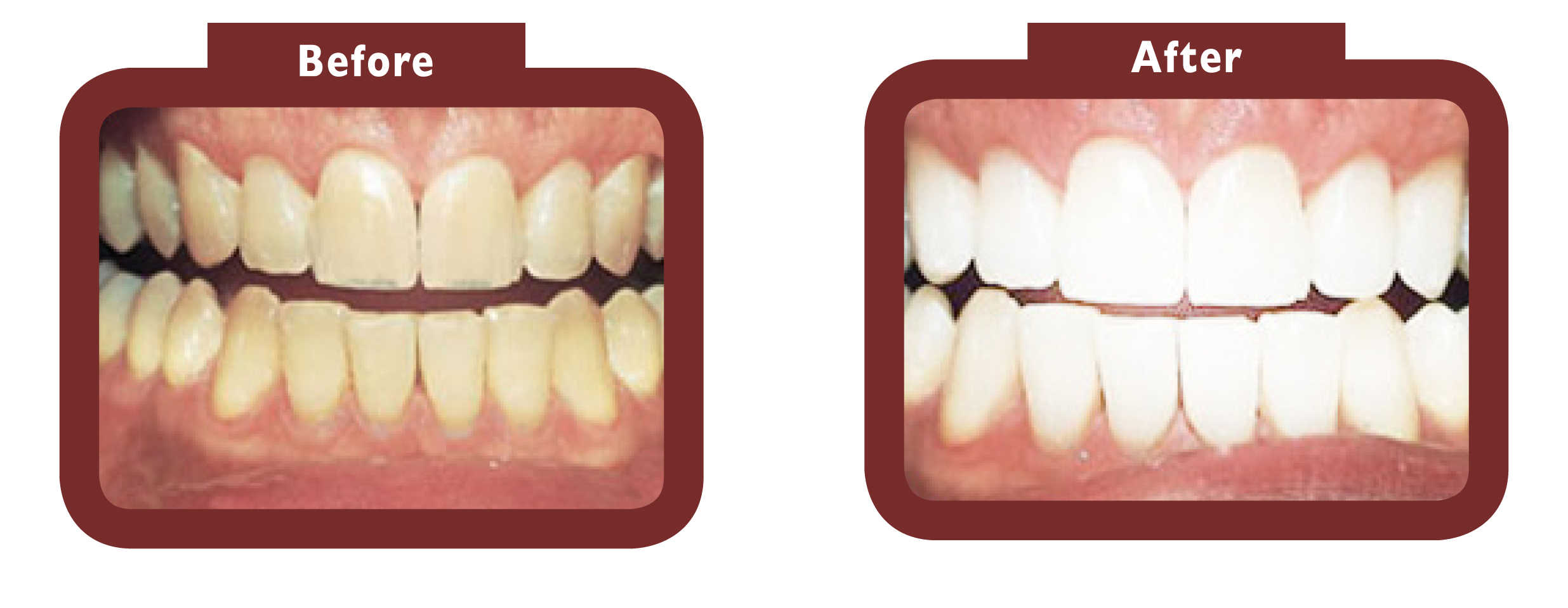 before and after teeth whitening - LA TEETH Slough