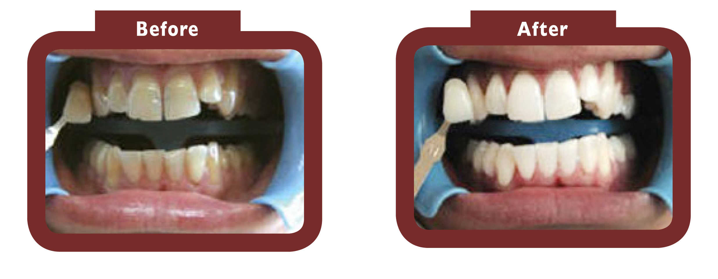 before and after teeth whitening - LA TEETH Slough