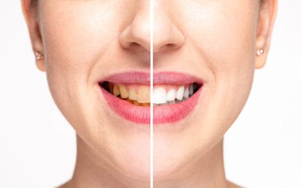 Teeth Whitening Milton Keynes Slough