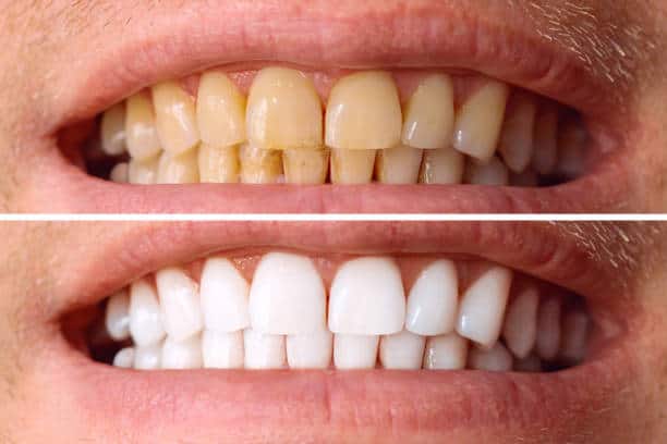 Laser White For Ever Bright – Get a Brighter, Whiter Smile with LA Teeth Whitening Slough