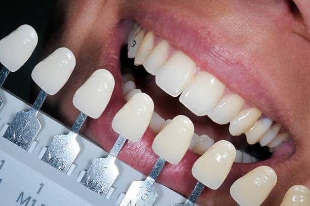 Get Natural and Stunning Smile with Teeth Whitening Results from LA Teeth Whitening Slough