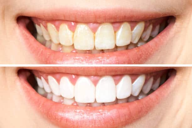 Achieve a Dazzling Smile for Your Special Day: A Guide to Wedding Teeth Whitening Slough