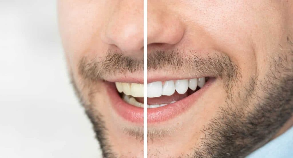 Teeth Whitening Bedfordshire Slough