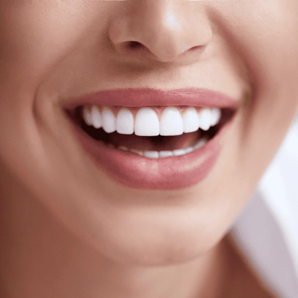 Get A whiter smile fast! Book with LA Teeth Whitening today! Slough