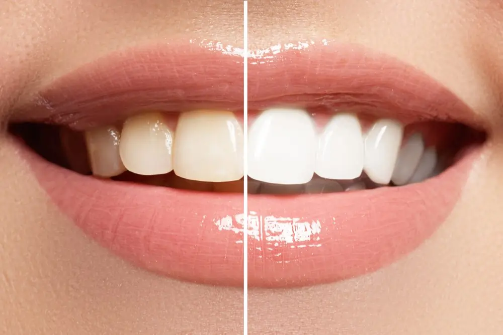 Smiling individual showcasing the visual effect of whiter, straighter-looking teeth Slough