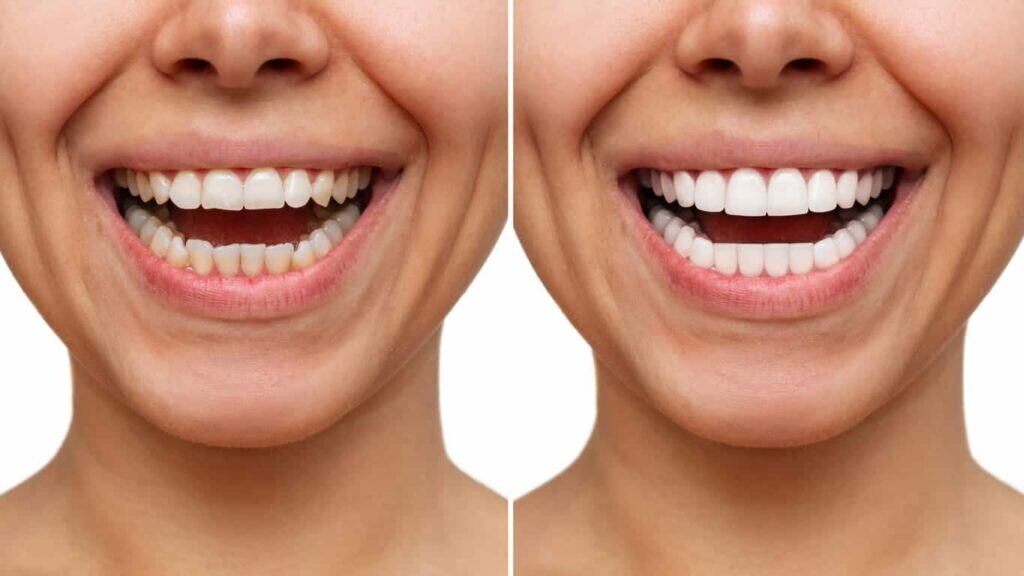Before-and-after image of teeth whitening, highlighting improved brightness and symmetry Slough