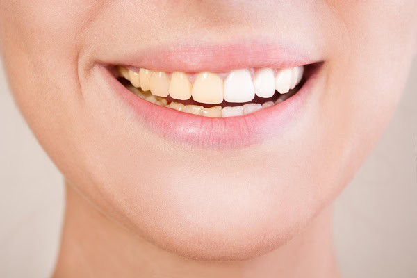 Can Whiter Teeth Make Them Look Straighter Slough