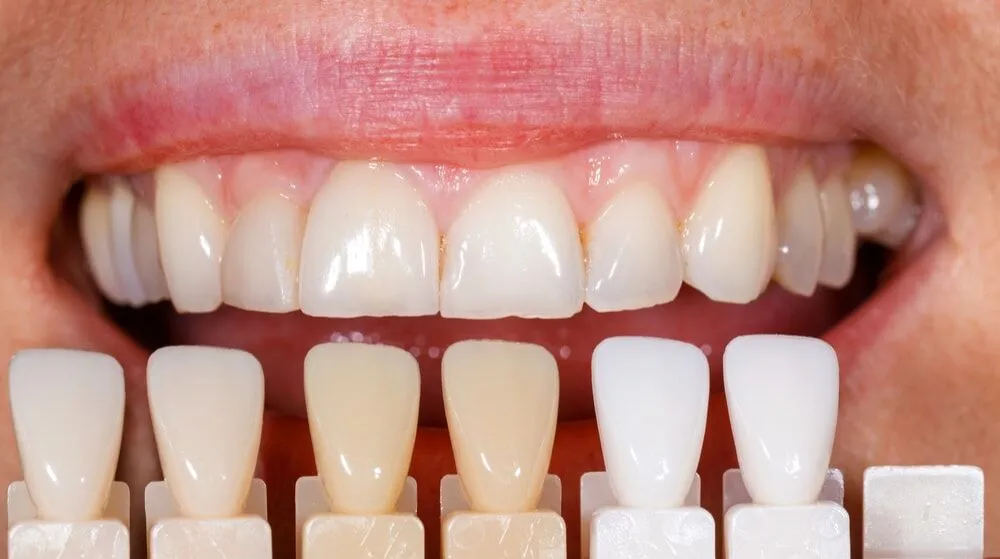 How Often Can I Have Teeth Whitening Slough
